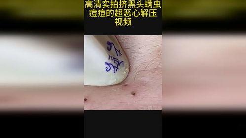 挤黑头粉刺解压视频成人,揭秘人生压力释放新方式