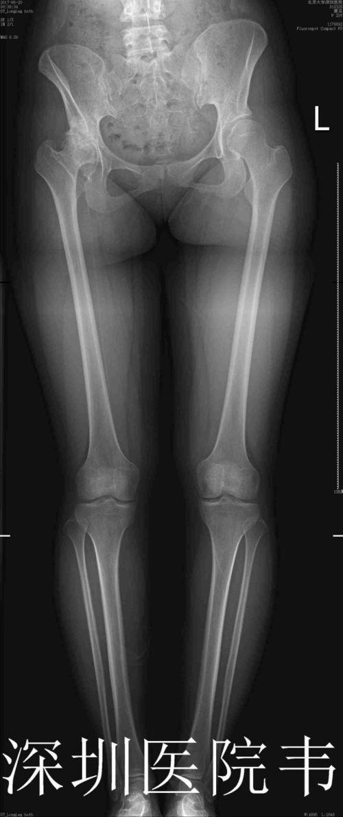 髋关节成人腿部牵引视频